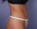 Liposuction Before and after photo