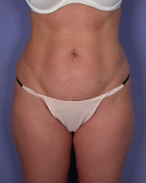 Liposuction before and after photo