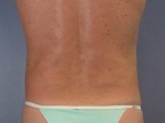 Liposuction Before and after photo