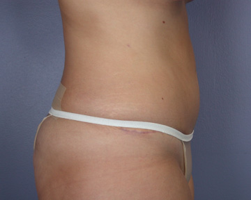 Liposuction before and after photo