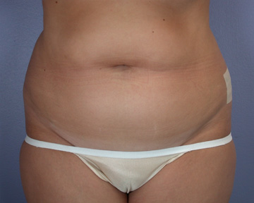 Liposuction before and after photo