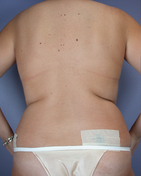 Liposuction before and after photo