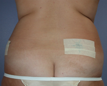 Liposuction before and after photo