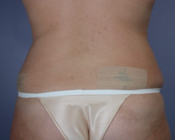 Liposuction before and after photo