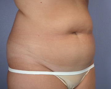 Liposuction before and after photo