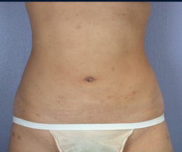 Liposuction before and after photo