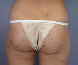 Liposuction before and after photo