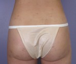 Liposuction Before and after photo