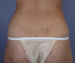 Liposuction before and after photo