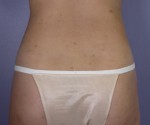 Liposuction Before and after photo