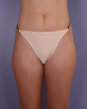 Liposuction before and after photo