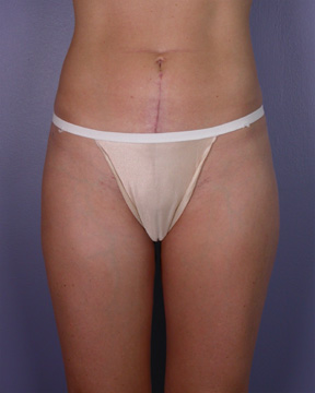 Liposuction before and after photo