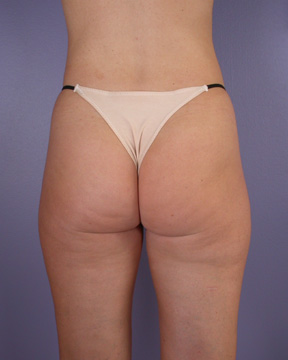 Liposuction before and after photo