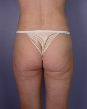 Liposuction before and after photo