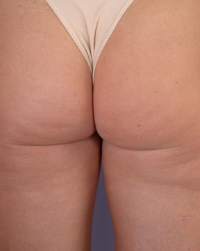 Liposuction before and after photo