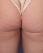 Liposuction Before and after photo