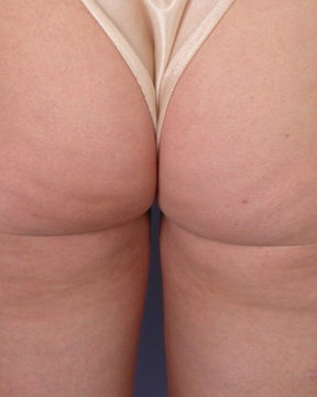 Liposuction before and after photo