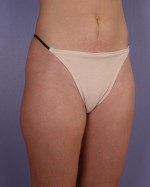 Liposuction Before and after photo