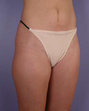 Liposuction before and after photo