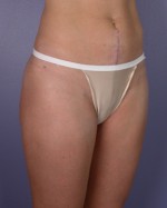 Liposuction Before and after photo