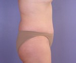 Liposuction Before and after photo