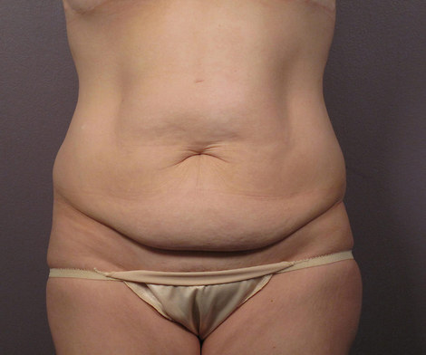 Liposuction before and after photo