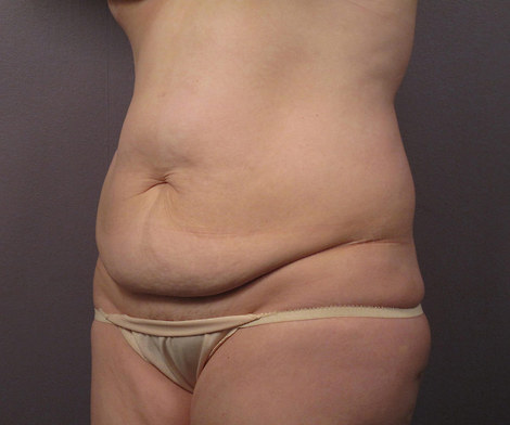 Liposuction before and after photo