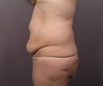 Liposuction Before and after photo