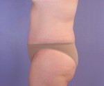 Liposuction Before and after photo