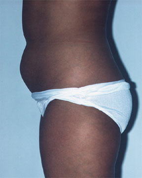 Liposuction before and after photo