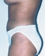 Liposuction