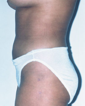 Liposuction before and after photo