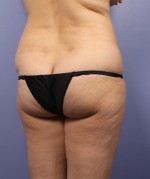 Liposuction Before and after photo