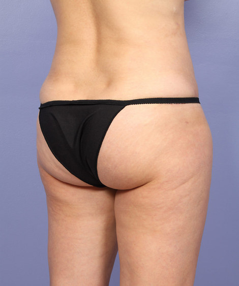 Liposuction before and after photo