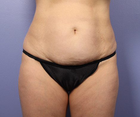 Liposuction before and after photo