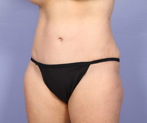 Liposuction before and after photo