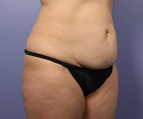 Liposuction before and after photo