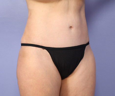 Liposuction before and after photo