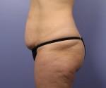 Liposuction Before and after photo