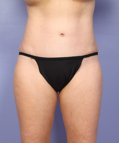 Liposuction before and after photo