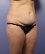 Liposuction Before and after photo