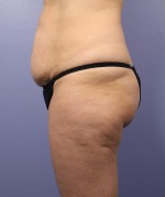 Liposuction Before and after photo