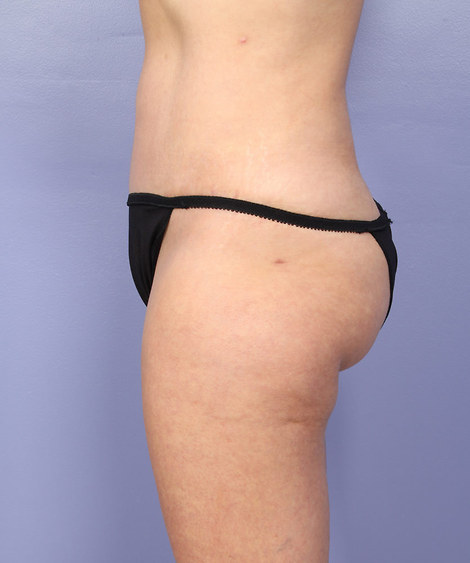 Liposuction before and after photo