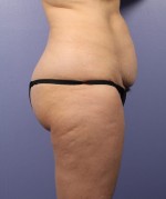 Liposuction Before and after photo