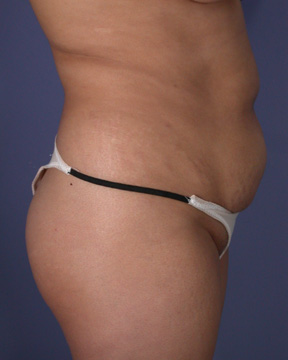 Liposuction before and after photo