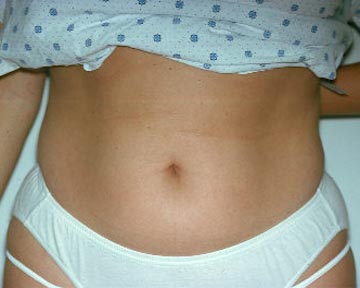 Liposuction before and after photo