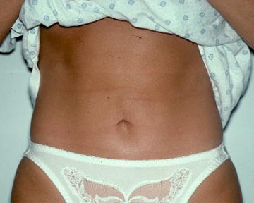 Liposuction before and after photo