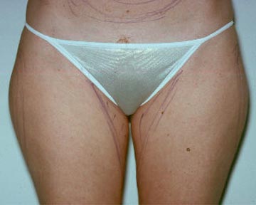 Liposuction before and after photo