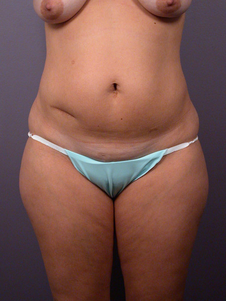 Liposuction before and after photo