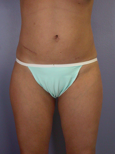 Liposuction before and after photo